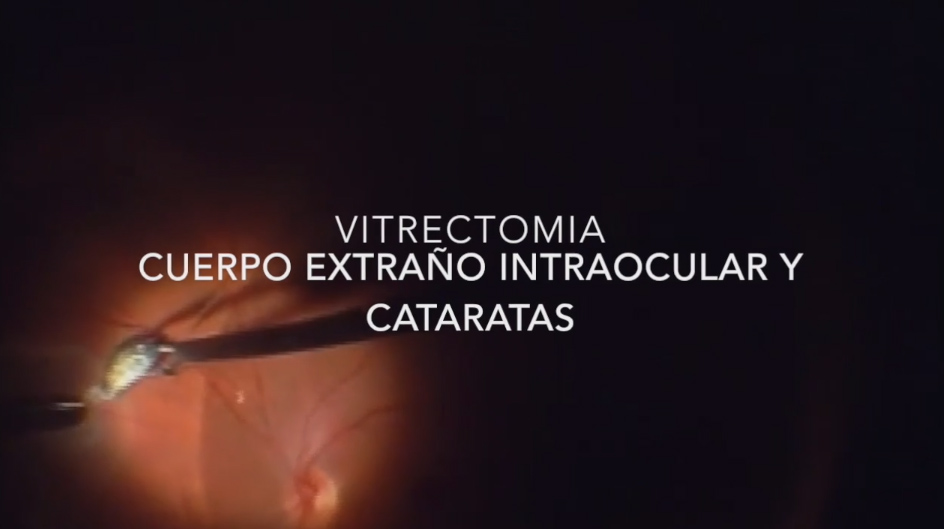 Vitrectomía. Cuerpo Extraño Intraocular y Cataratas